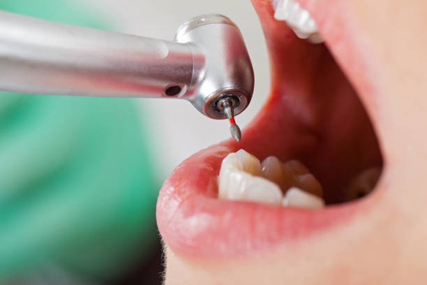 Best Emergency Root Canal Treatment in Bonner Springs, KS
